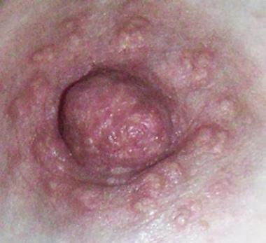 CARCINOMA ESCAMOSO ADENOIDE