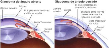 GLAUCOMA DE ÁNGULO CERRADO