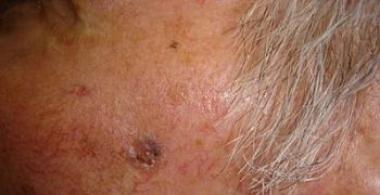 QUERATOSIS ACTÍNICA ACANTOLÍTICA