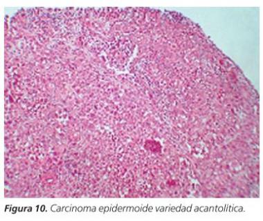 QUERATOSIS ACTÍNICA ACANTOLÍTICA