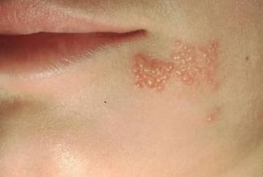 HERPES SIMPLE TIPO I
